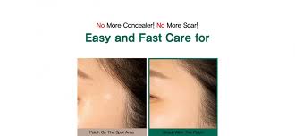 Some By Mi 30 Days Miracle Clear Spot Patch - 18 pcs